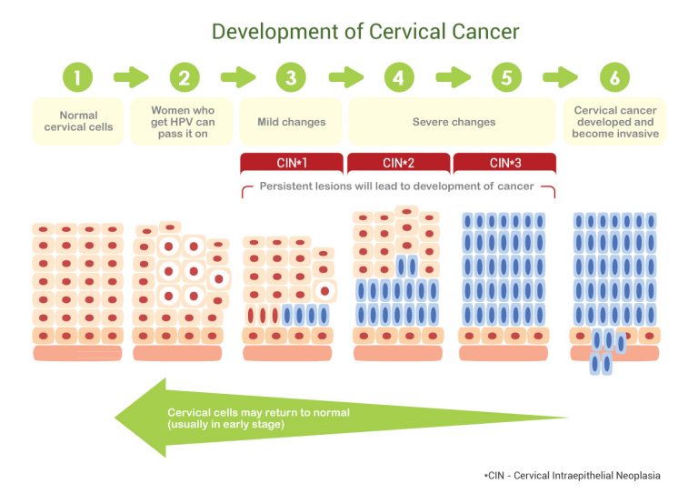 How Does Hpv Lead To Cervical Cancer Cwsc 7791